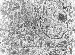 M, 47y. | chromophobic pituitary adenoma (ACTH)